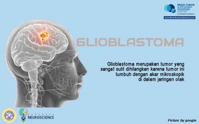 Kenali GLIOBLASTOMA lebih dalam